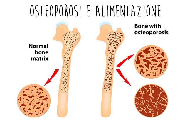Patologie: Osteoporosi? Un aiuto dall’alimentazione